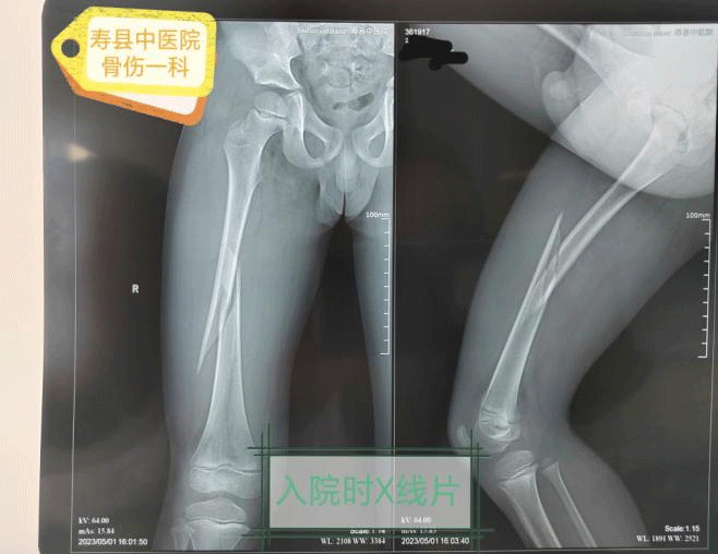 寿县中医院成功开展弹性髓内钉治疗儿童股骨骨折